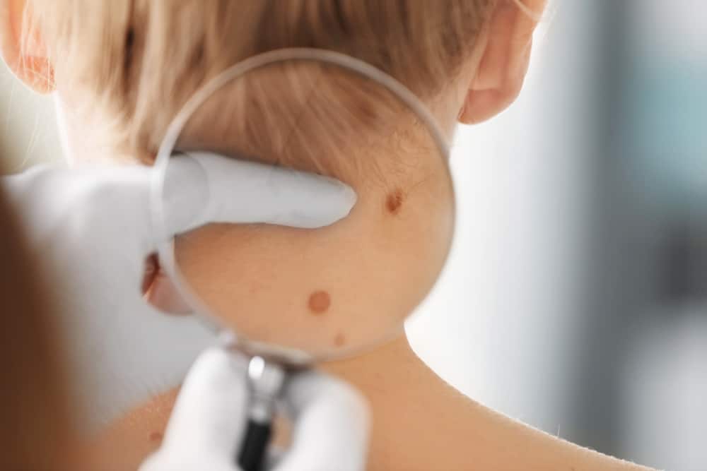 cách trị mụn nước