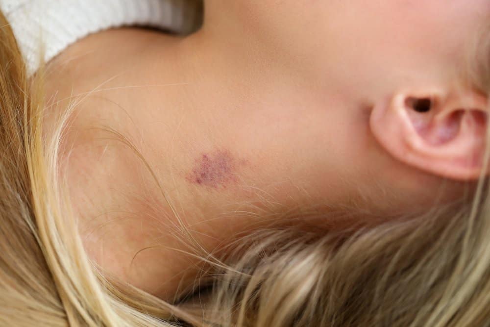 hickey có nguy hiểm không