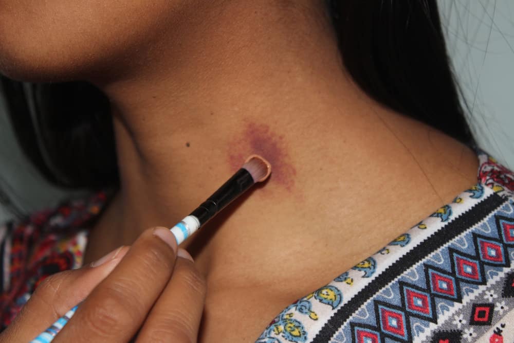 hickey có nguy hiểm không