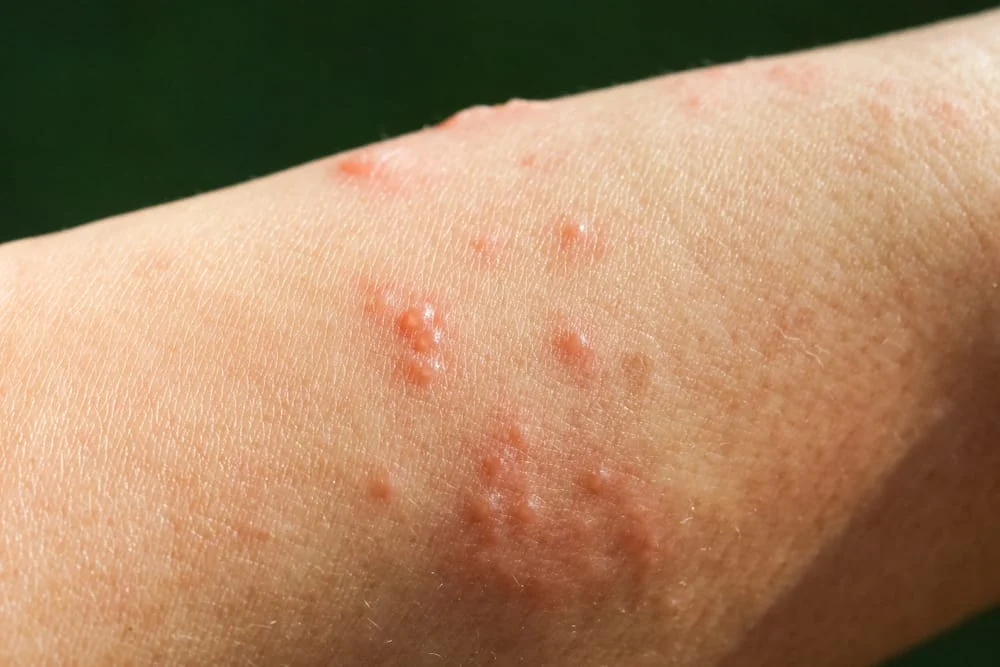 triệu chứng mụn nước
