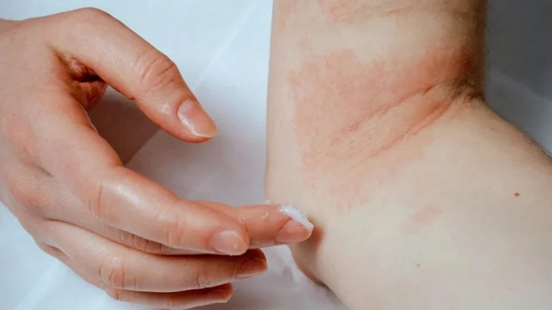 cách sử dụng fucidin cream