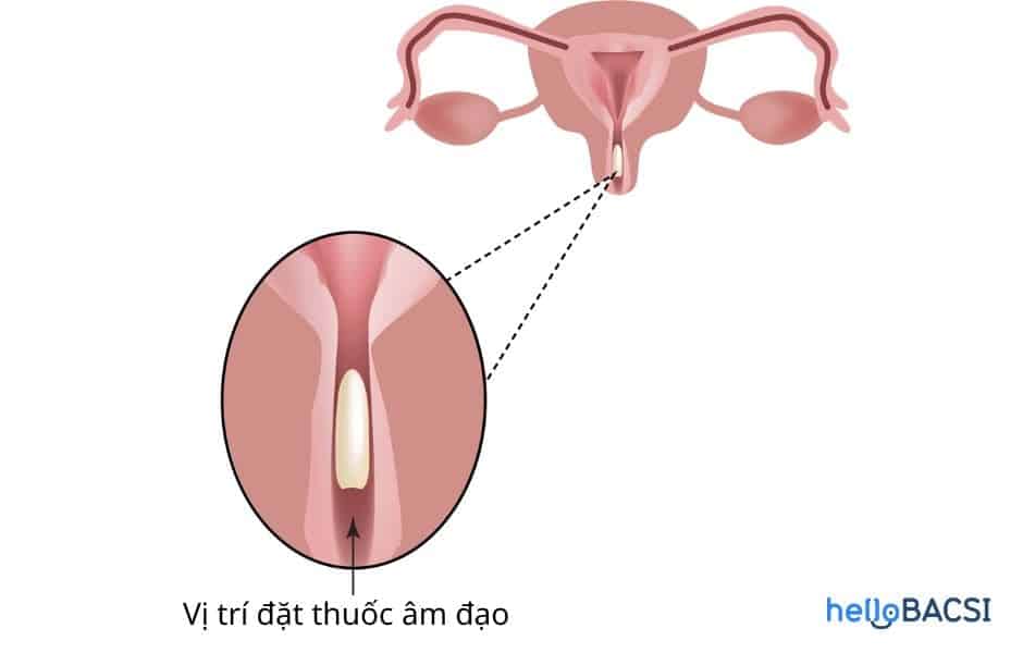 Đặt thuốc phụ khoa bao lâu thì rửa? Cách vệ sinh vùng kín sau khi đặt thuốc